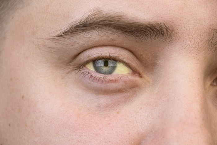 Foto mostra close-up de olho de um homem com tonalidade amarelada - Metrópoles *- icterícia