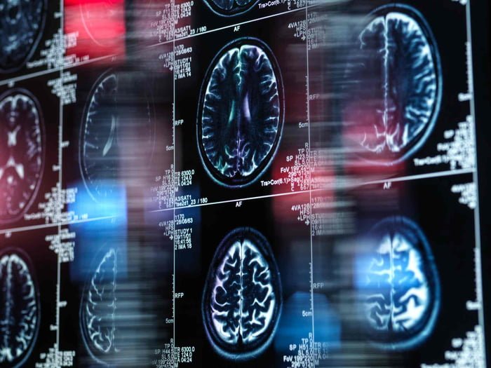 Foto mostra imagens de uma radiografia do cérebro alzheimer