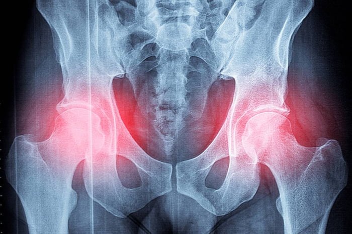 Imagem colorida de raio x que mostra osteoporose em paciente - Metrópoles