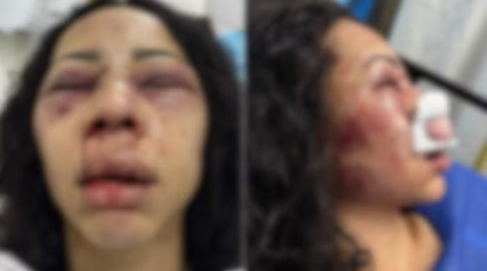 imagem colorida. Turista brasileira com rosto inchado após agressão
