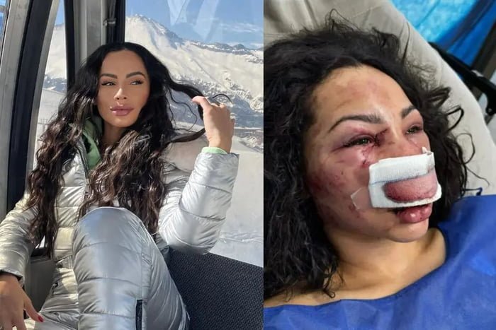 Imagem colorida de mulher assaltada no Chile - Metrópoles